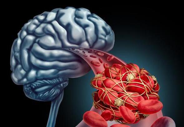 腦中風后一般能活多久