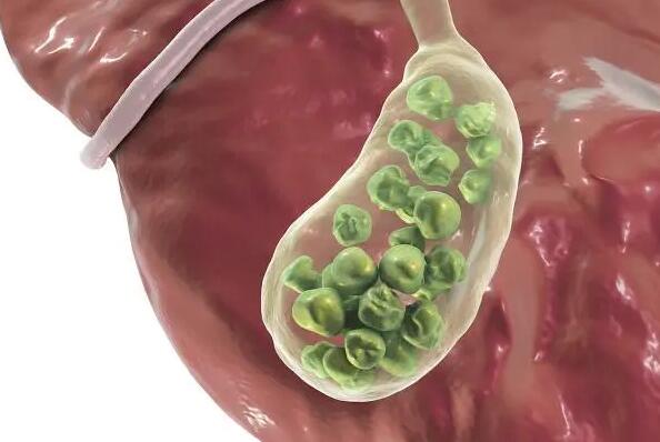 得了膽結(jié)石不能吃什么食物 膽結(jié)石飲食需要注意什么 得了膽結(jié)石不能吃什么食物 膽結(jié)石飲食需要注意什么