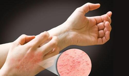 接觸性皮炎是什么原因引起的 接觸性皮炎是什么原因引起的