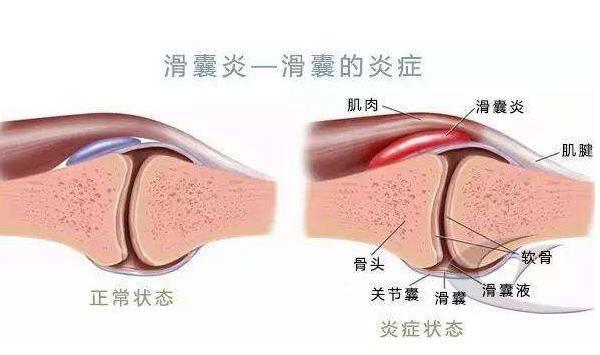 滑囊炎的癥狀是什么