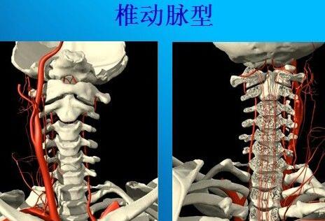 椎動脈型頸椎病診斷標準 椎動脈型頸椎病診斷標準