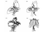 巴德-吉亞利綜合征