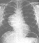 非結(jié)核性分枝桿菌病