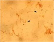 鉤端螺旋體肺炎