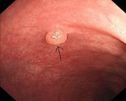 老年人結腸息肉