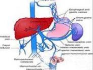 特發性非硬化性門脈高壓綜合征