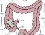 小兒回盲腸綜合征