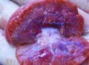 腎動脈血栓形成和栓塞