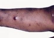 小兒維斯科特-奧爾德里奇綜合征