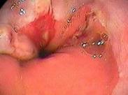 食管賁門粘膜撕裂綜合征