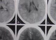 神經系統副腫瘤綜合征