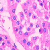 腎嗜酸細(xì)胞瘤