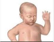 先天性腹壁肌肉發(fā)育不良