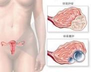 卵巢黃體囊腫破裂