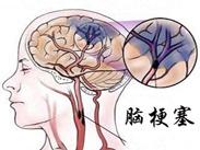 腦梗塞