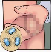 男性生殖器官感染