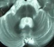 夏伊-德雷格綜合征