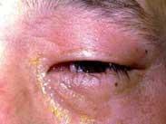 眼瞼痙攣-口下頦部肌張力障礙