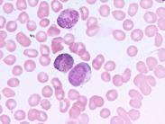 小兒成人型慢性粒細(xì)胞白血病