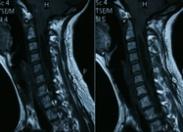 小兒后顱窩型腦積水綜合征