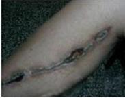 梭狀芽胞桿菌傷口感染