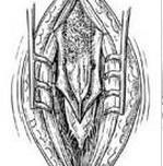 脊髓拴系綜合征