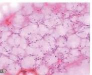 間充質(zhì)軟骨肉瘤