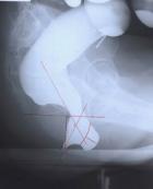 恥骨直腸肌綜合征