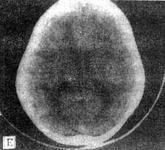 小兒球形細胞腦白質營養不良