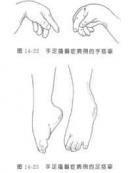 嬰兒手足搐搦癥