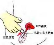 外傷性乳房脂肪壞死