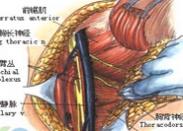 胸長神經卡壓癥