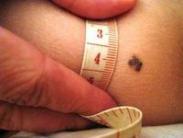 原發(fā)性皮膚免疫細胞瘤