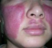 小兒系統性紅斑狼瘡