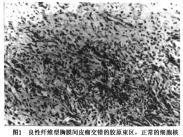 局限性胸膜間皮瘤