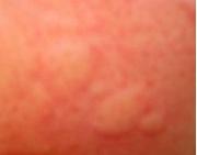 陣發性冷性血紅蛋白尿