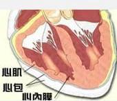 心內膜彈性纖維增生癥