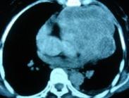 心包內惡性畸胎瘤